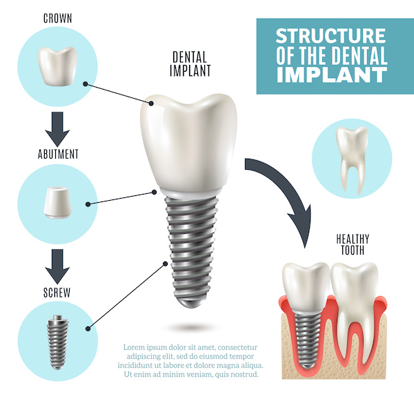 implants