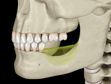 Bone Grafting