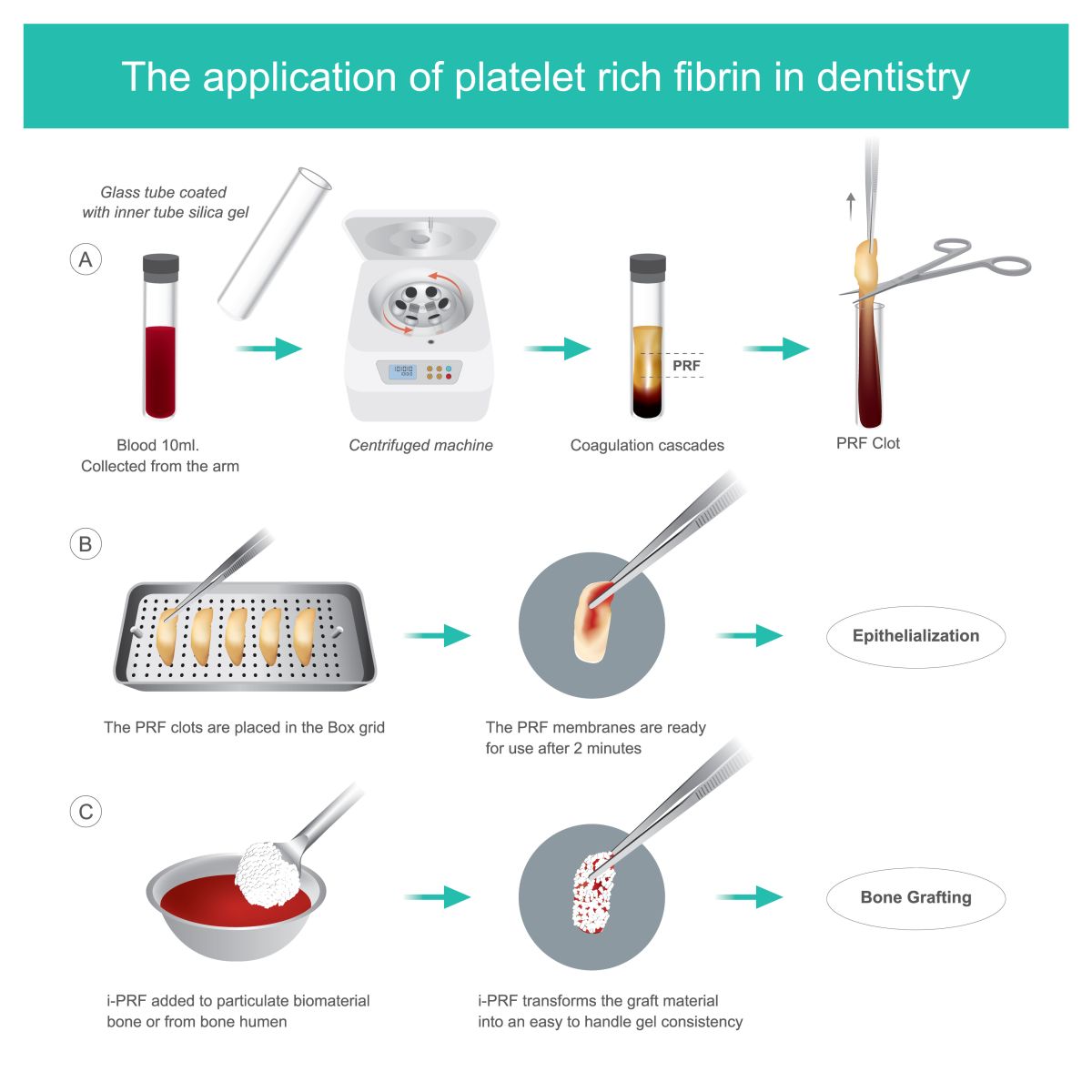 Platelet  Rich Fibrin