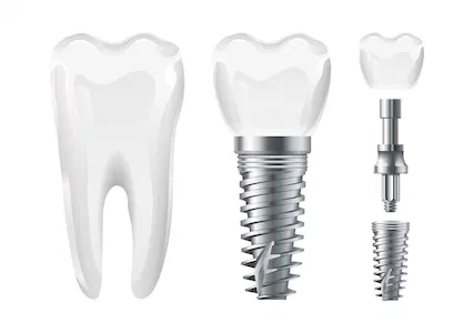 Implant patient